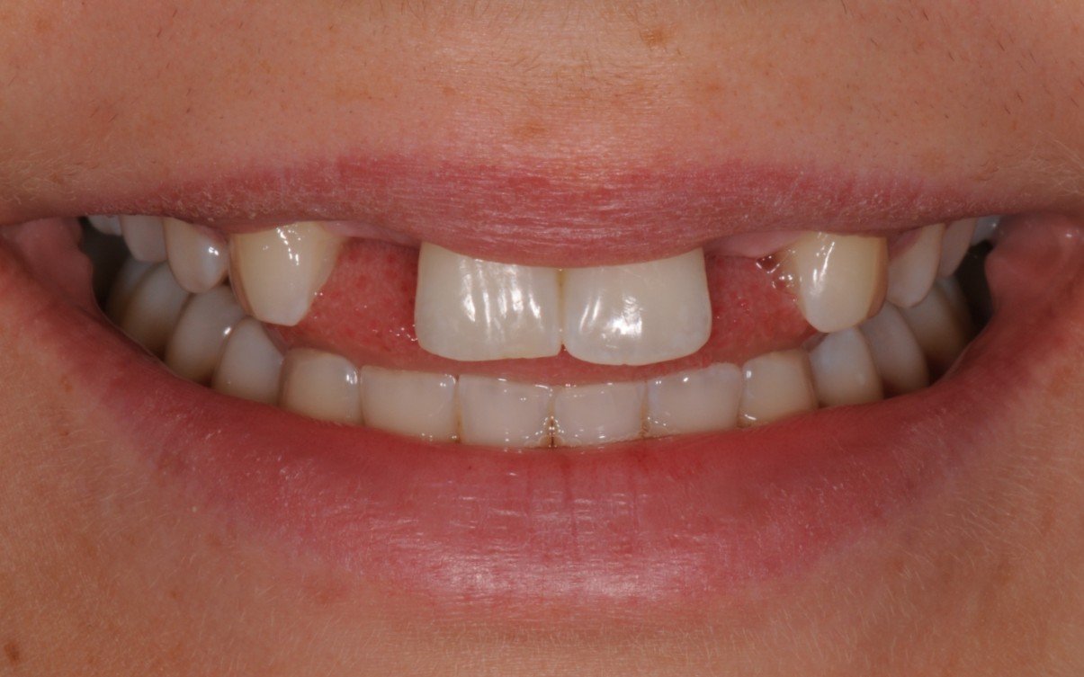 Resin Bonded Bridges Discover Dental Wellington