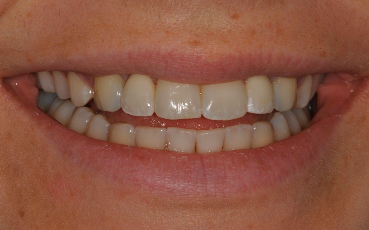 Resin Bonded Bridges Discover Dental Wellington