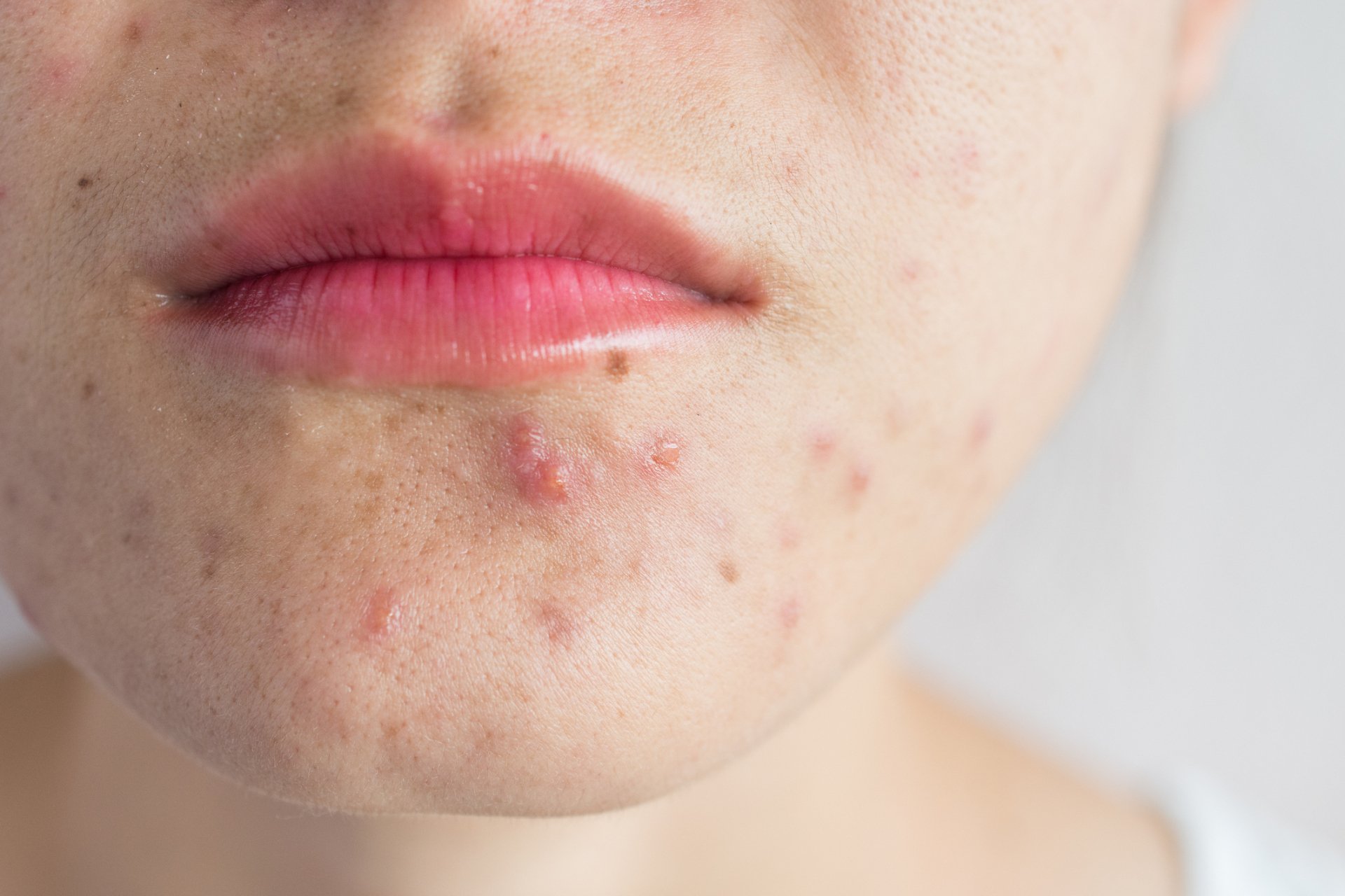 Skin Treatment New Port Richey FL New Image Dermatology Skin treatment new port richey fl new image dermatology
