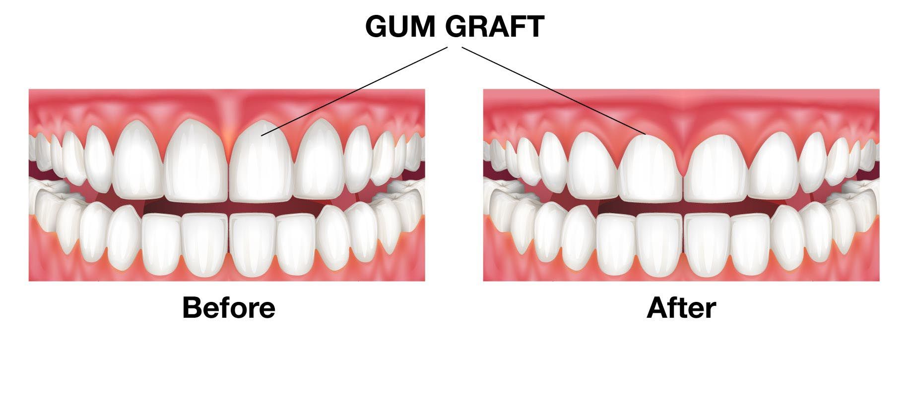 Gum Grafting in North Vancouver Implant Perio Centre Northshore