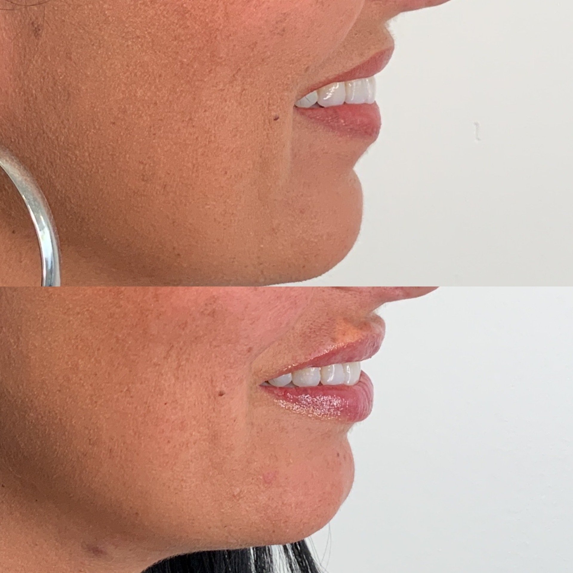 Laser Hair Removal, Microdermabrasion, & Botox Near Lexington, KY