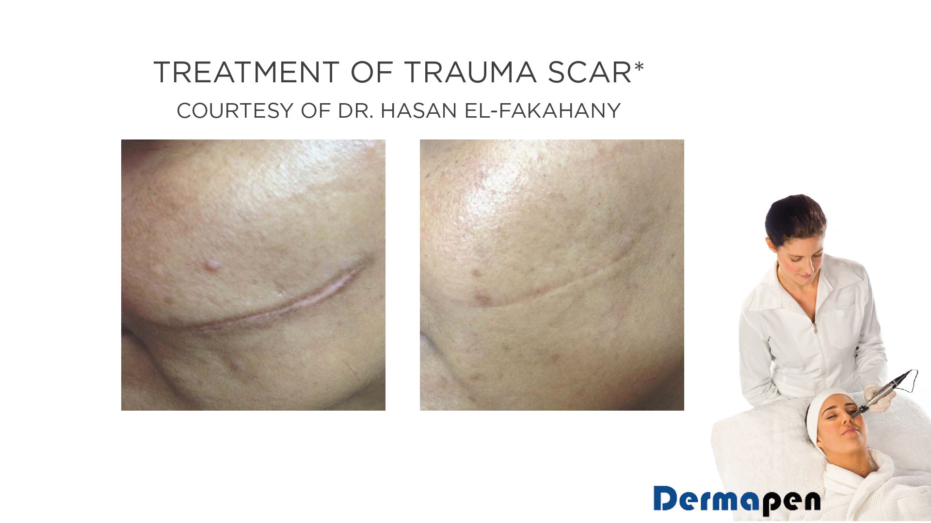 Scar Therapy Johannesburg Dr Anton Brewis
