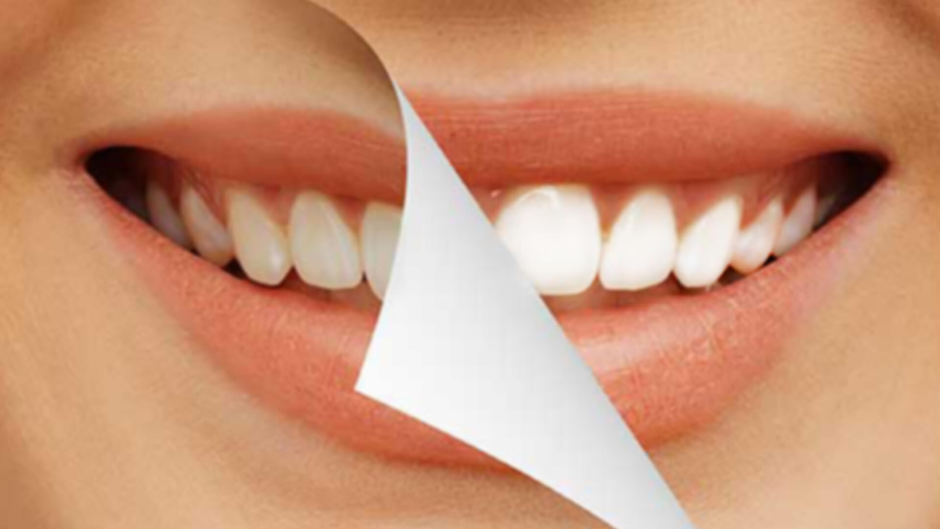Clareamento Dental Laser ou Caseiro?