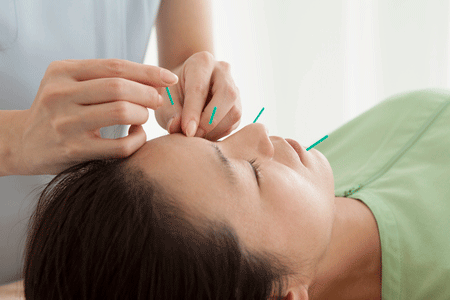 Acupuncture