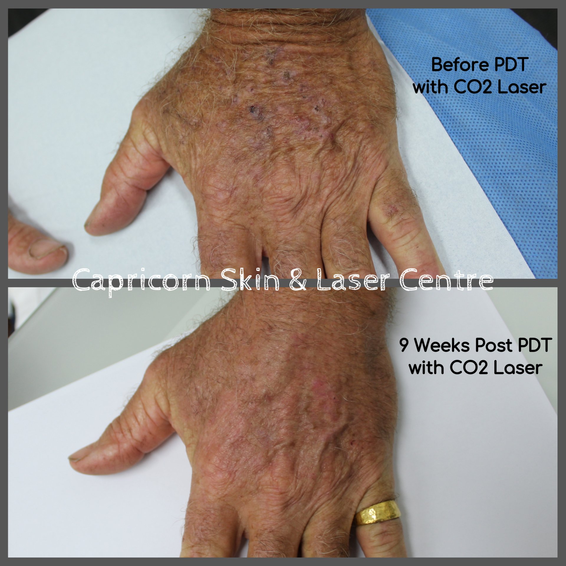 Photodynamic Therapy Central Queensland Skin Laser Centre Skin photodynamic-therapy-central-queensland-skin-laser-centre-skin