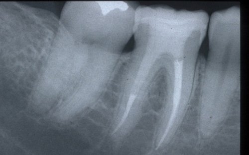 Dente Devitalizzato Che Fa Male Dopo Anni