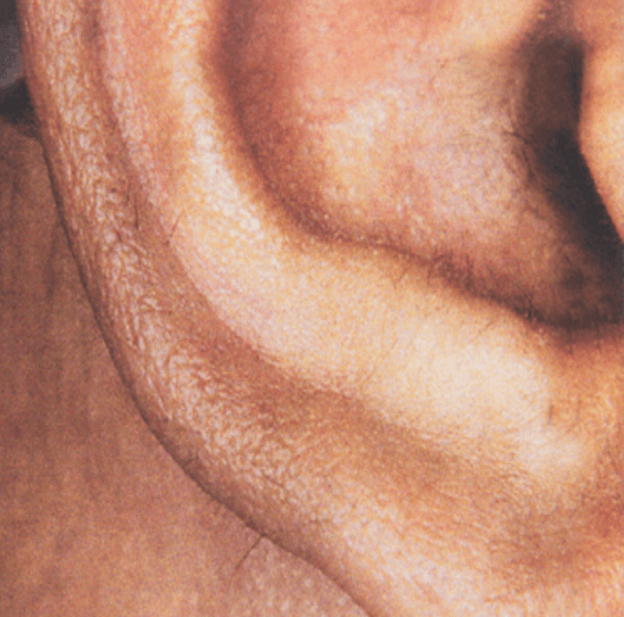 Laser Hair Removal Treatments in Chicago Dr Yates Lifestyle Medspa