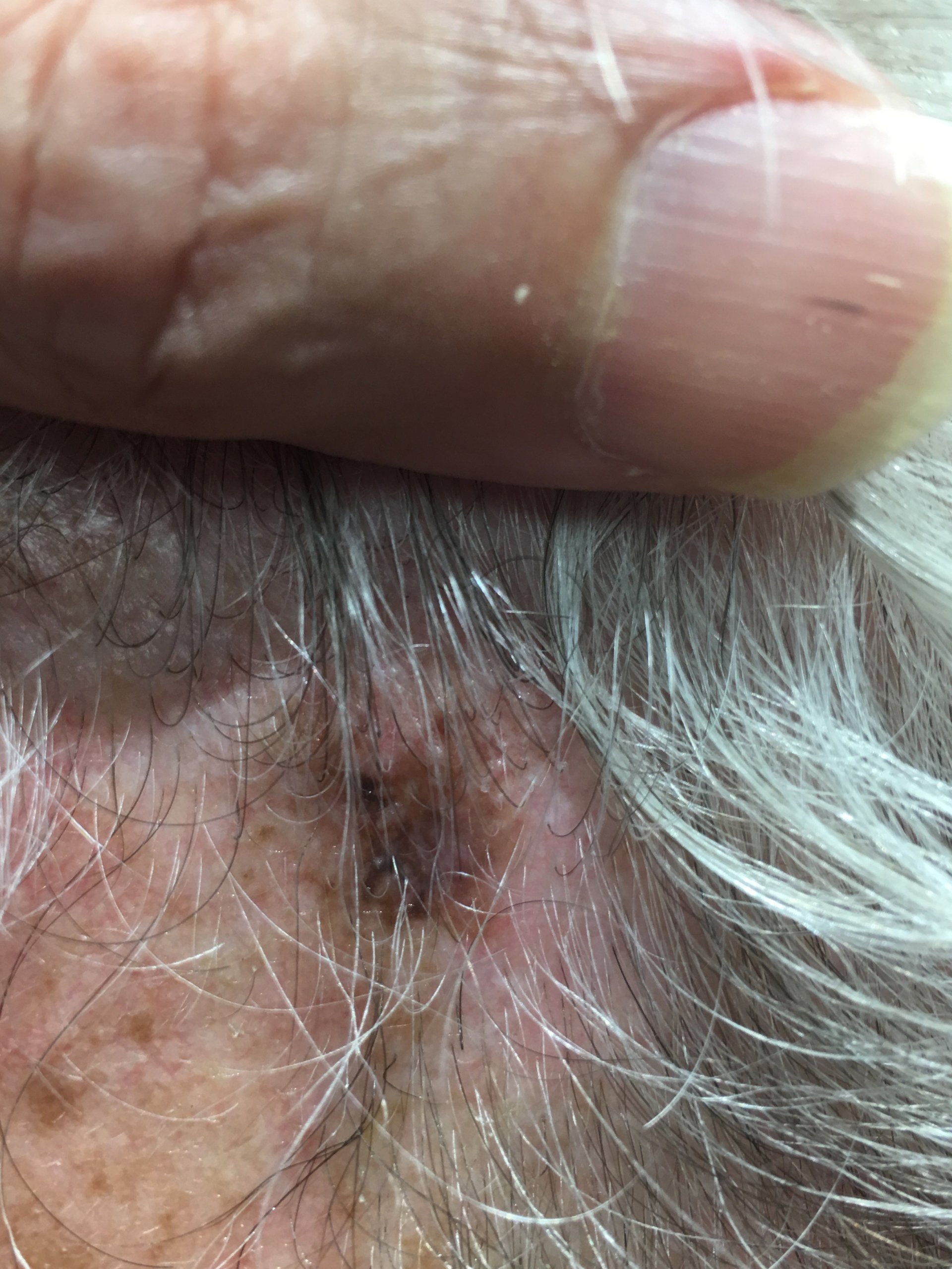 Is It Melanoma?