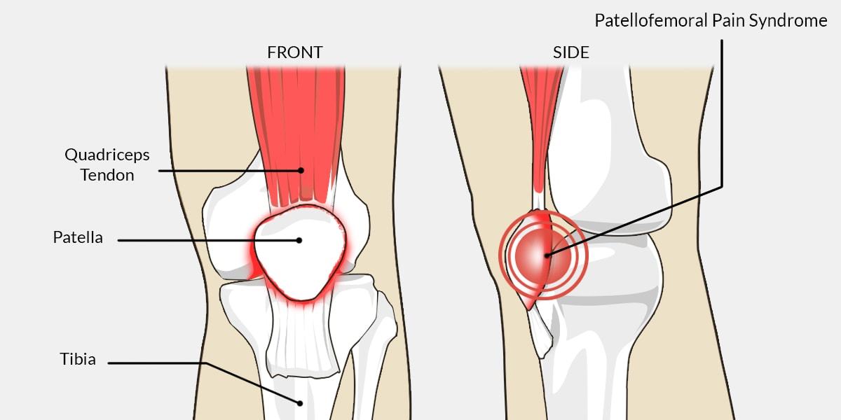 patellofemoral syndrome pfps patella femoral syndrome