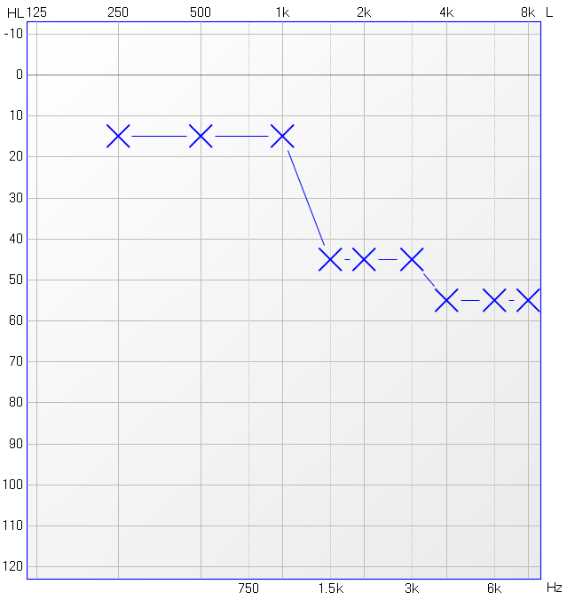 What Are Hearing Aid Channels Hearing Insider