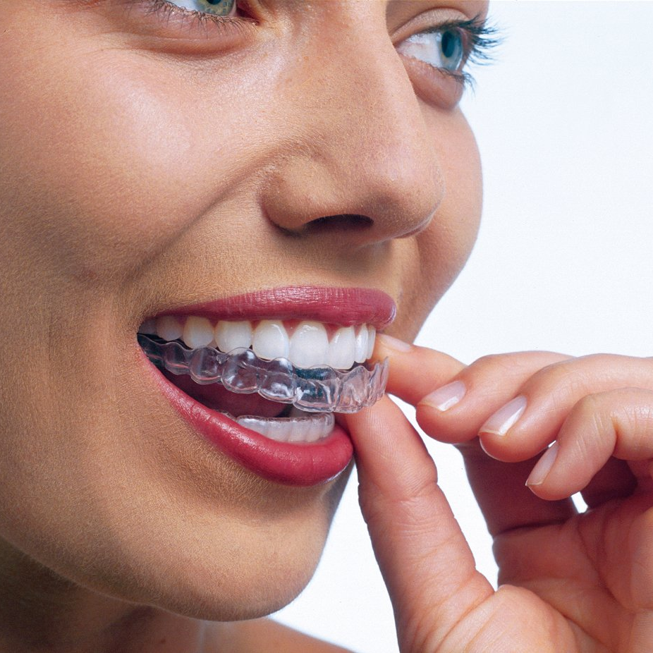 Lady with Invisalign Aligners - Invisalign Christchurch