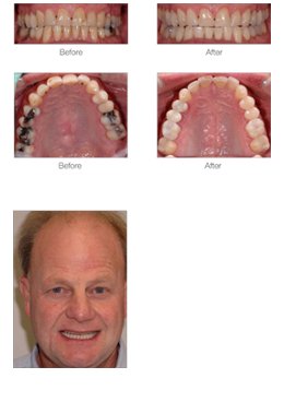 Functional Makeover - Tooth Whitening Case Study at Duxton Dental Christchurch