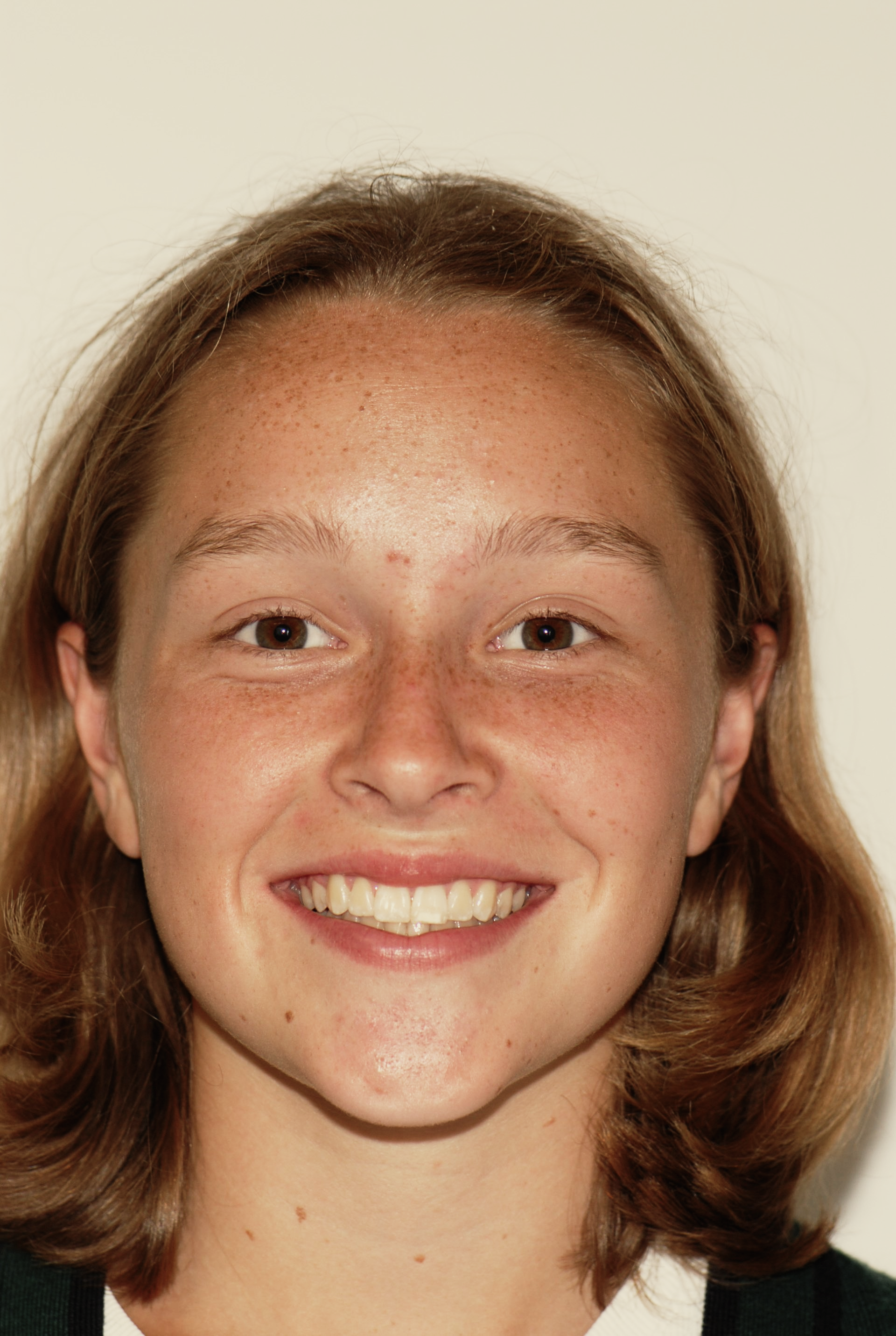 Girl smiling - teeth whitening christchurch - Duxton Dental