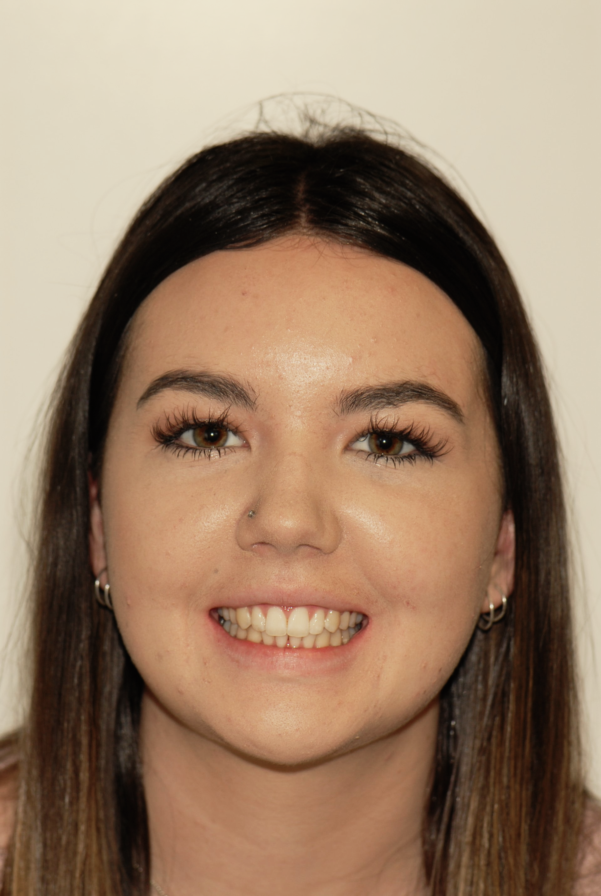 Girl smiling - teeth whitening Christchurch - Duxton Dental