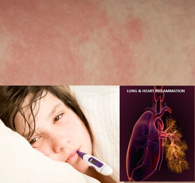 Still's Disease Awareness Day