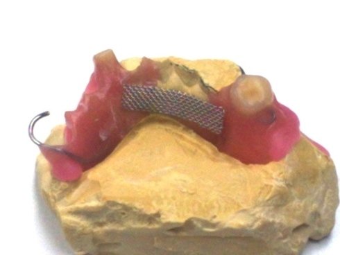 What Is A Soft Reline In Dentures At Raymond Degregorio Blog - Foto 8