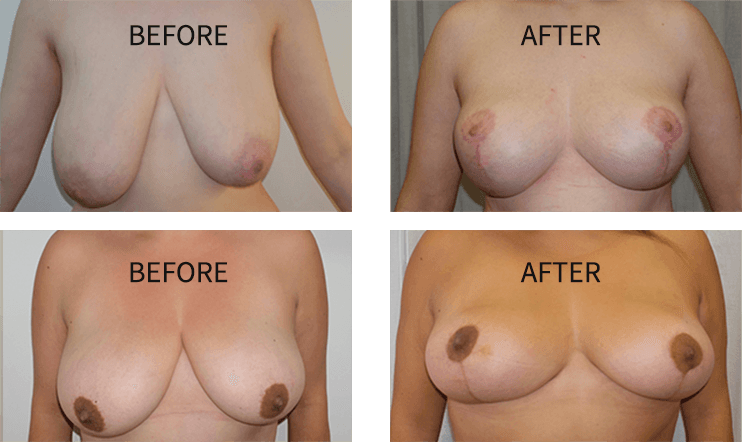 breast before and after