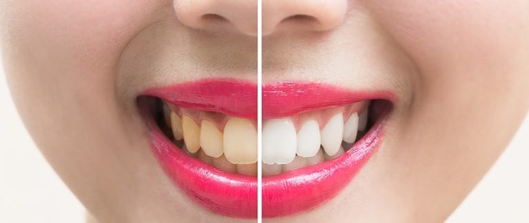 How To Get Rid of Yellow Teeth