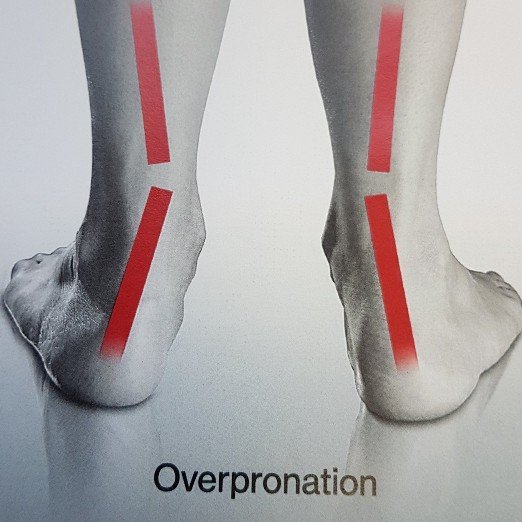 Treatments for bunions Kettering Foot Health Clinic