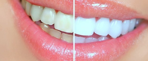 Teeth- Tooth Whitening Cosmetic Dentist Marina Del Ray