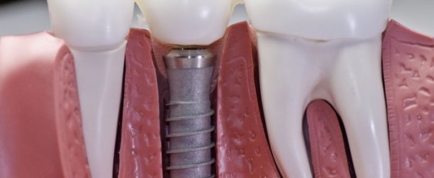 Cosmetic Dentistry Marina Del Ray Dental Implants Dental Implants Marina Del Ray Cosmetic Dentist