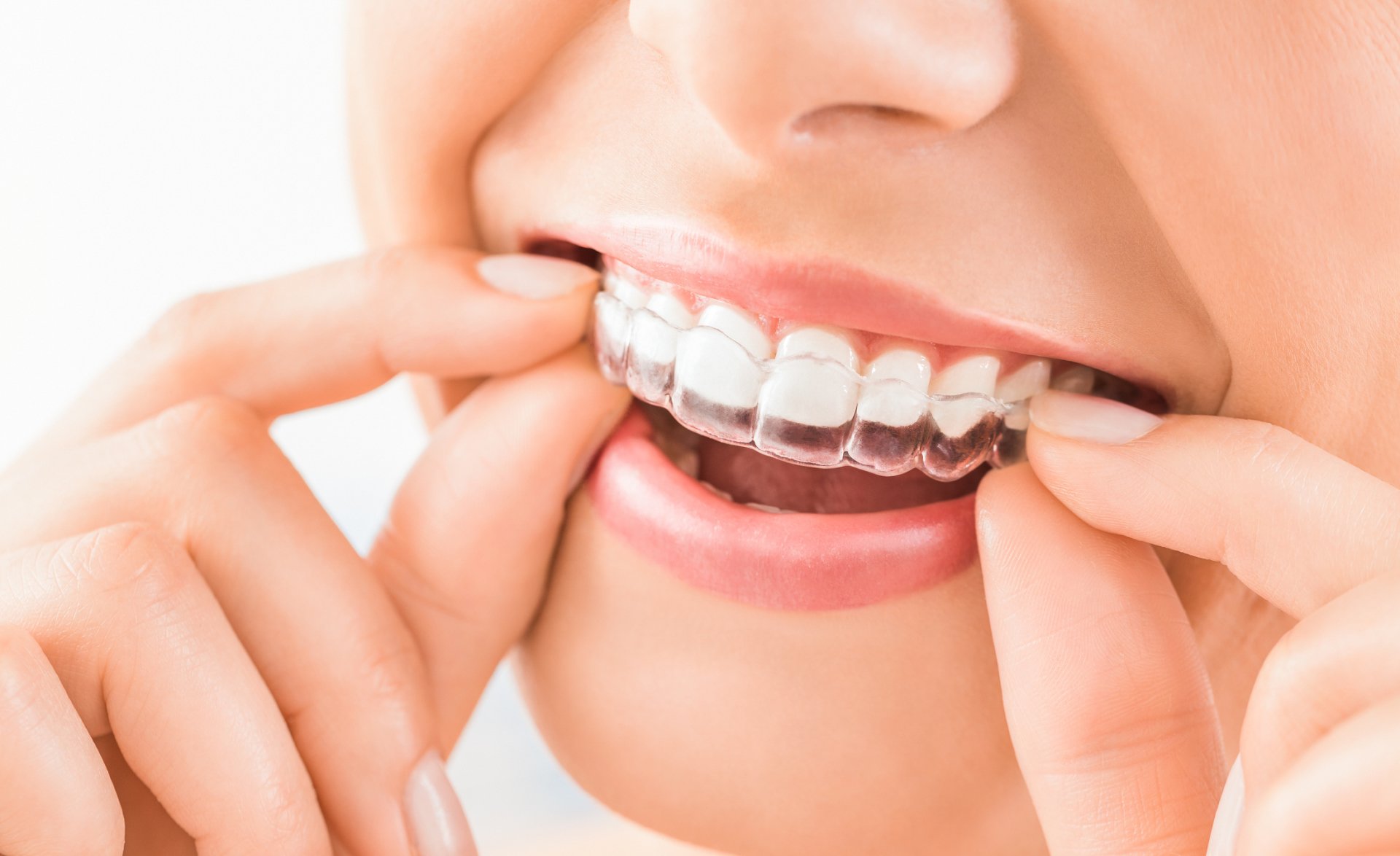 Clear Aligners An Alternative to Braces for Adults