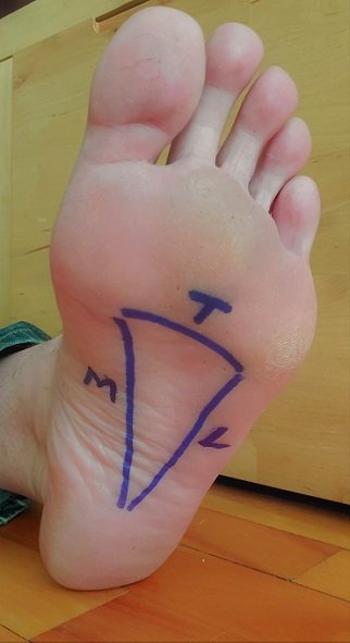 High Arched Foot