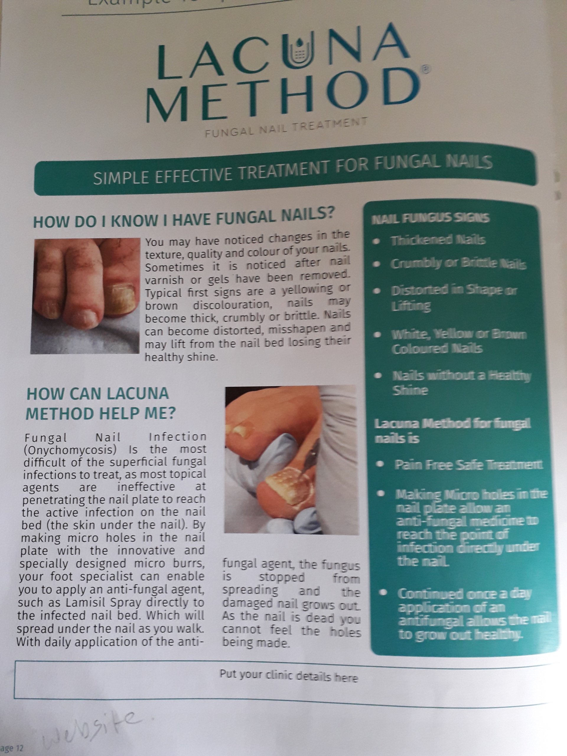 Fungal nail treatment East Ham Podiatry in Newham, East London