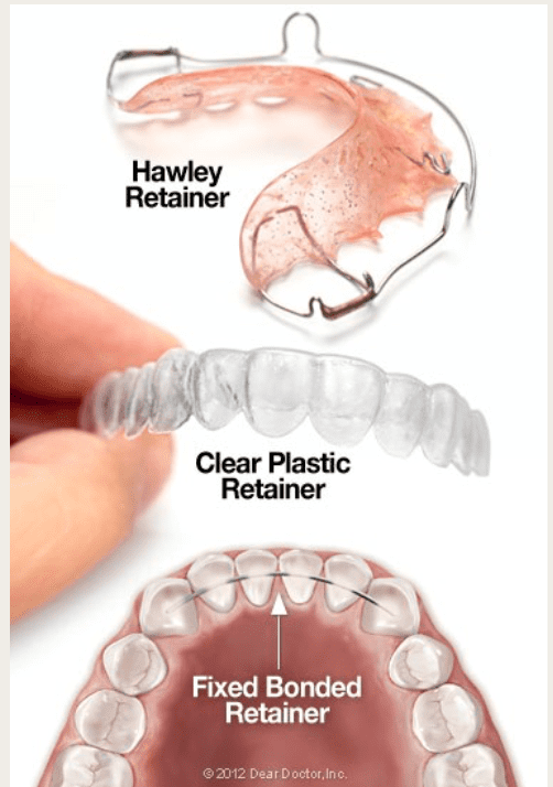 Why Retainers After Orthodontic Treatment are VERY IMPORTANT