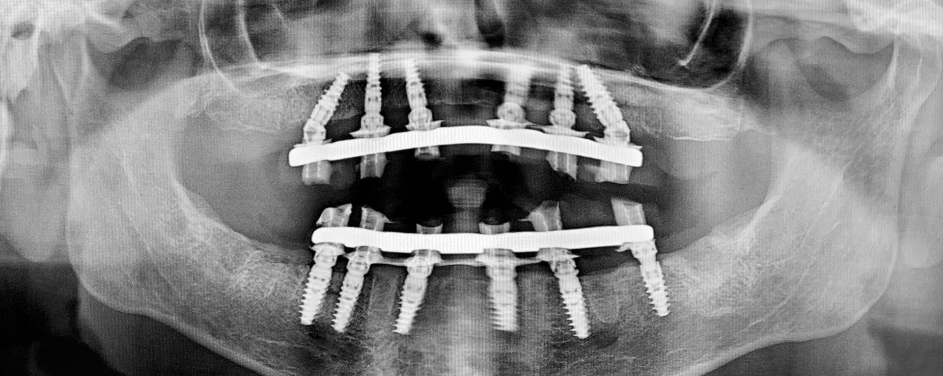 Teeth In An Hour l Lancaster, PA l Conestoga Oral Surgery