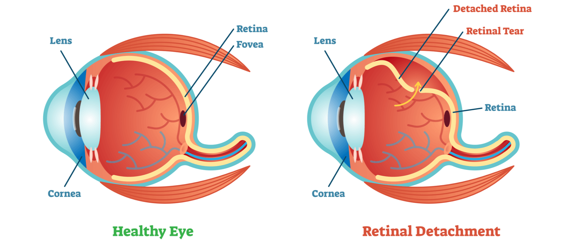 Retinal Detachment Talley Eye Institute