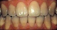 sbiancamento dentale
