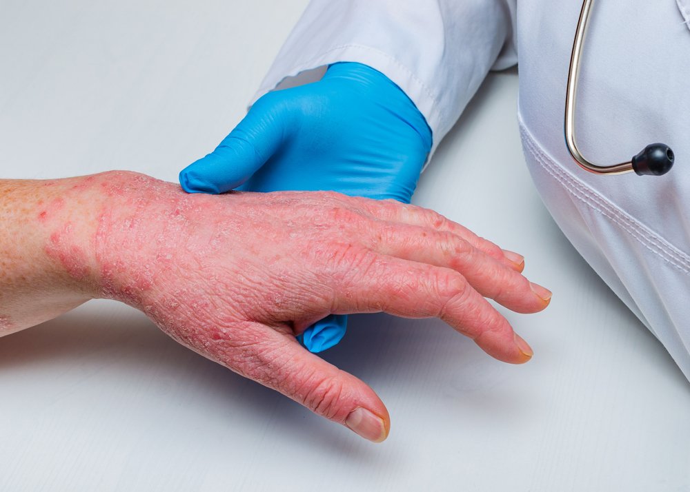 Hives Hickory, NC Hickory Allergy & Asthma Clinic