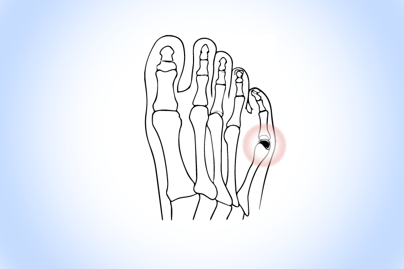 Bunions & Foot & Ankle Rehab Clinic Nedlands