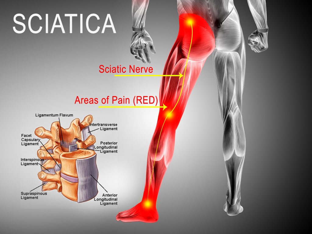 sciatic-nerve-pain-in-leg-femoral-nerve-roots-l2-l3-l4-front