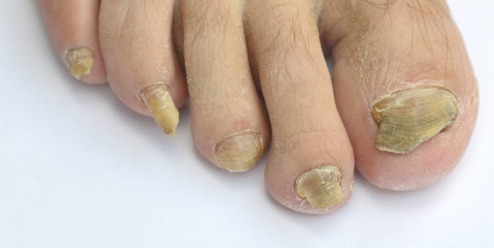 Best 11+ Candida Diet Foods To Avoid List