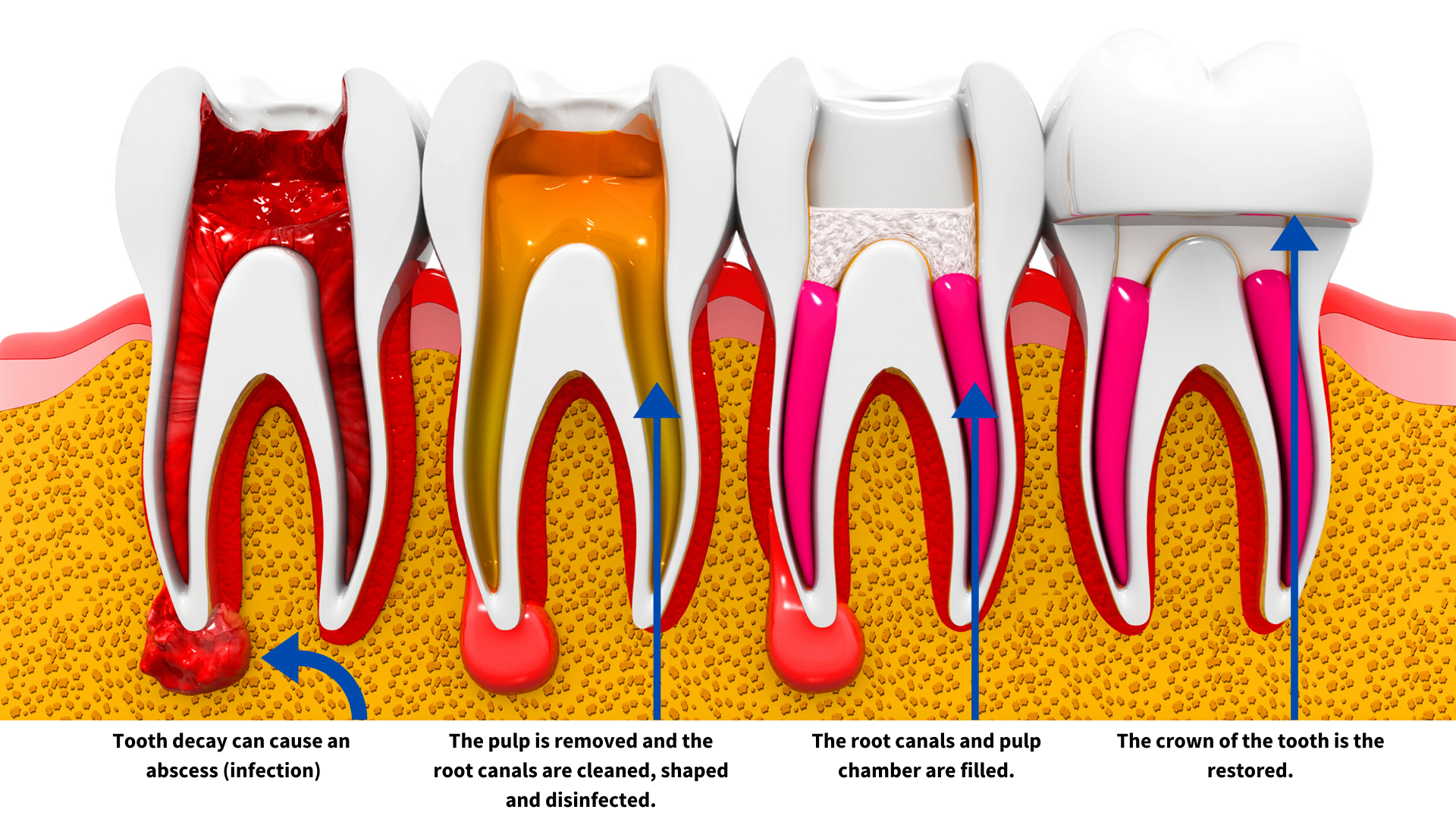 Root Canal Therapy Pembroke Dental Associates Pembroke Pines, FL