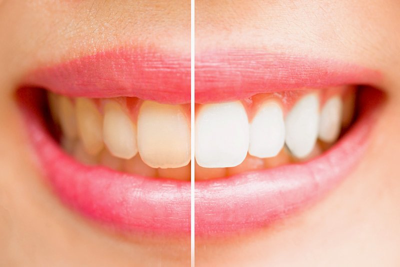 tooth whitening before and after