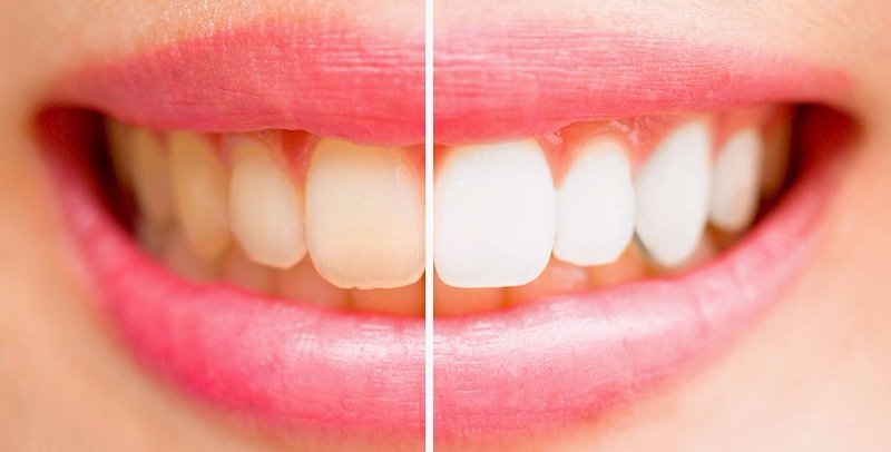 Before and after teeth whitening in Hobart