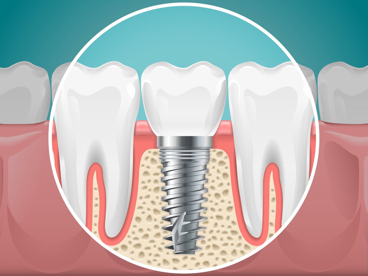 Dental Implants Service In Las Vegas, NV Sunbrite Dental