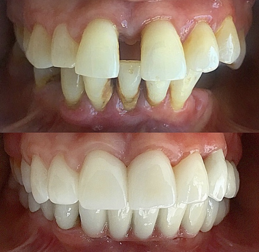 Save as much as 70 on Zirconia Veneers in Turkey UK Smiles