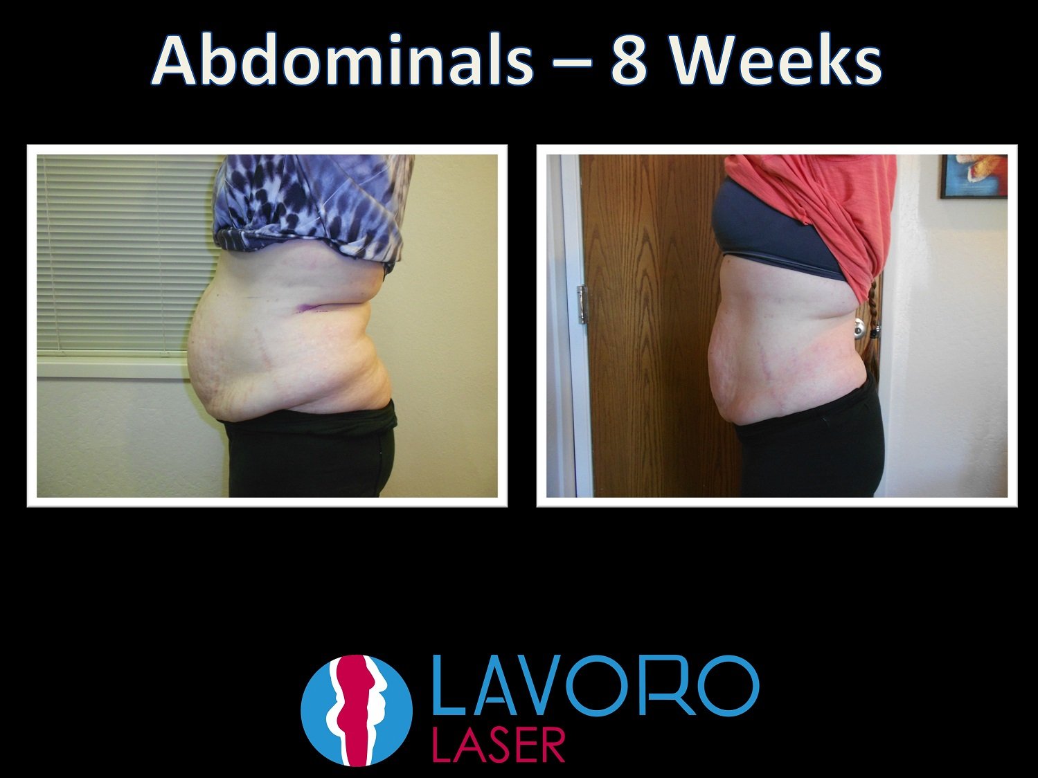 Before & After Gallery Walnut Creek, CA Lavoro Laser