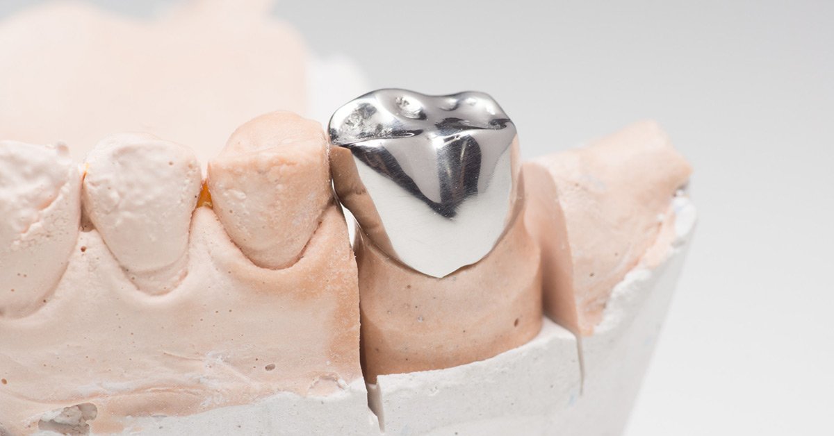 What Is A Dental Crown What To Expect When Getting A Dental Crown