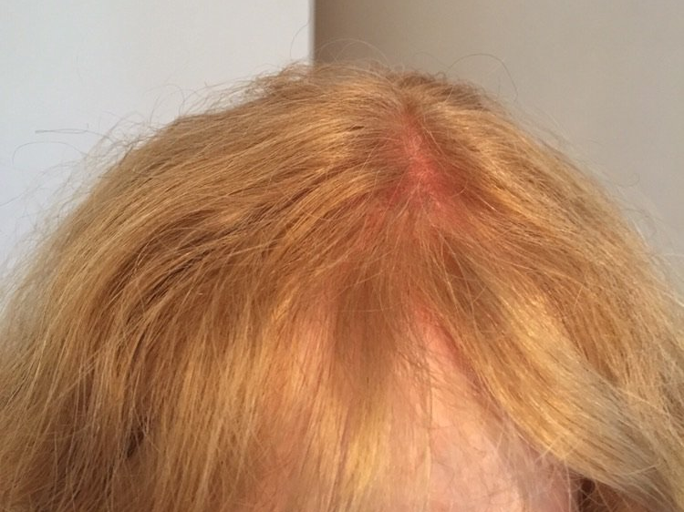 The Wig Gallery Hair Loss Alopecia Balding Tampa Wethersfield