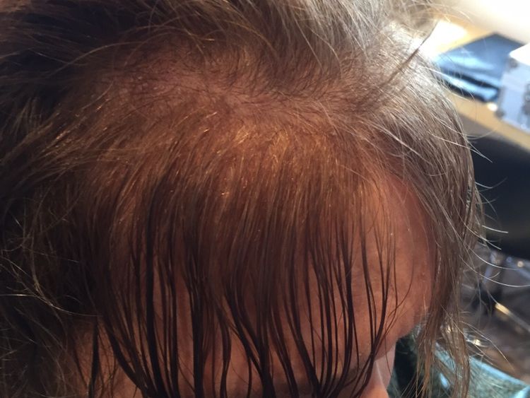 The Wig Gallery Hair Loss Alopecia Balding Tampa Wethersfield