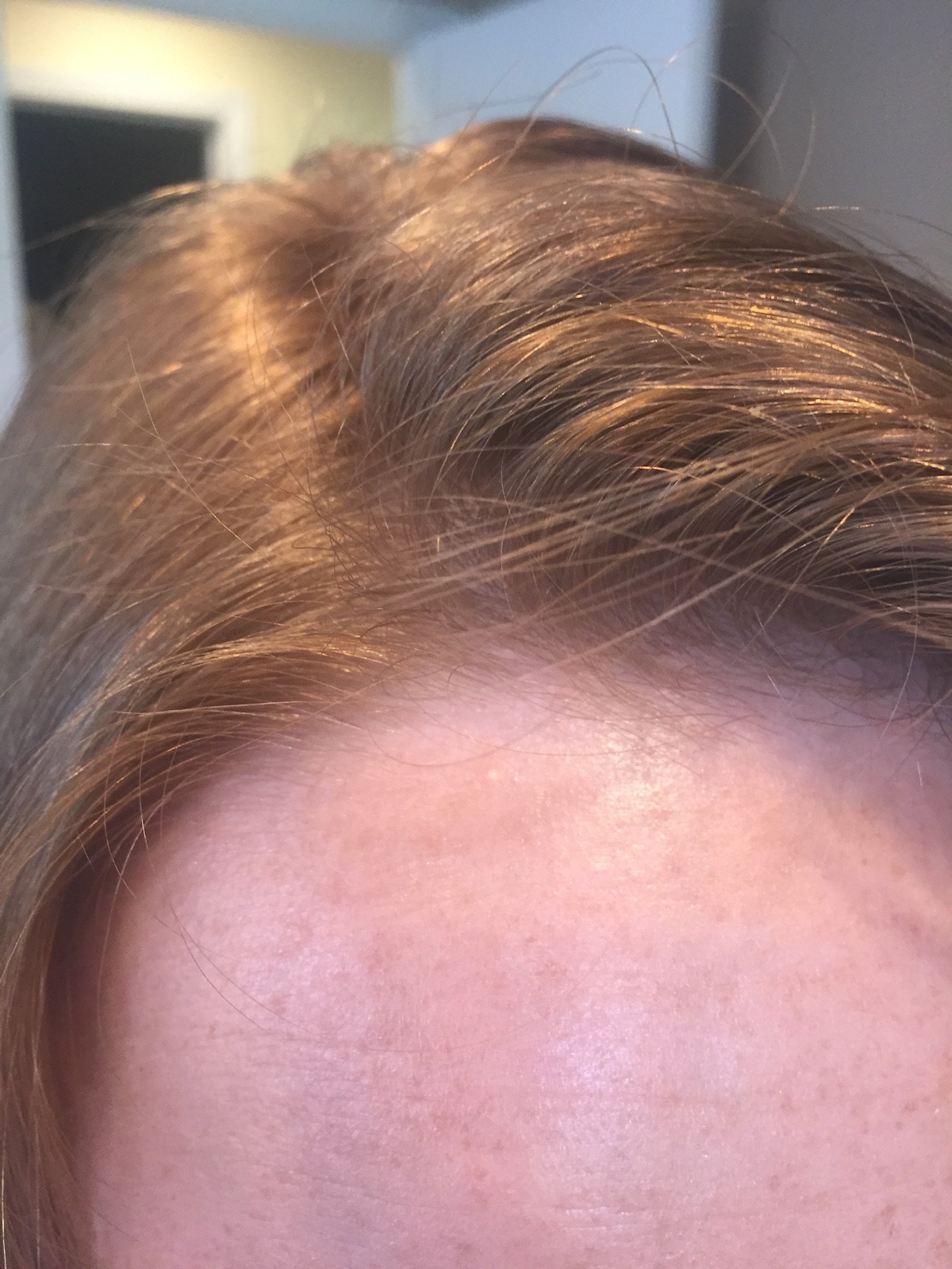 The Wig Gallery Hair Loss Alopecia Balding Tampa Wethersfield