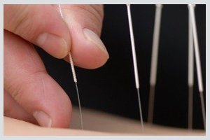 adelaide physiocare and sports acupuncture close view acupuncture adelaide physiocare and sports acupuncture close view acupuncture