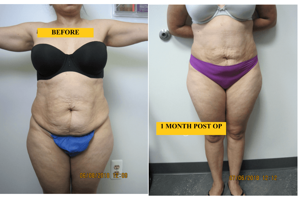 Best Laser and Water liposuction in Baltimore (410) 7680262