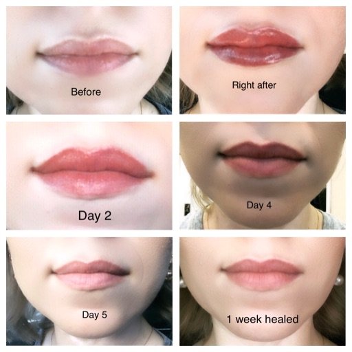 Mastectomy Bras Chemical Peels Surprise, AZ