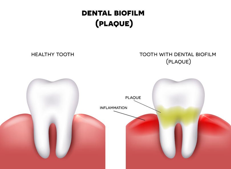 Plaque Disease Meaning In Urdu at Matthew Cole blog